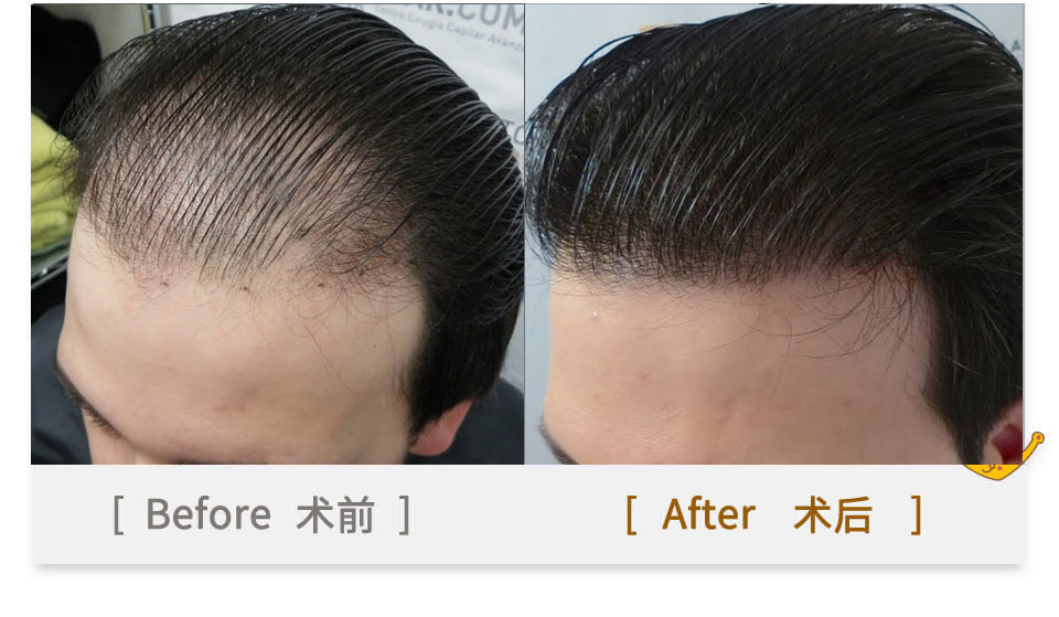 hairline transplant for men in china