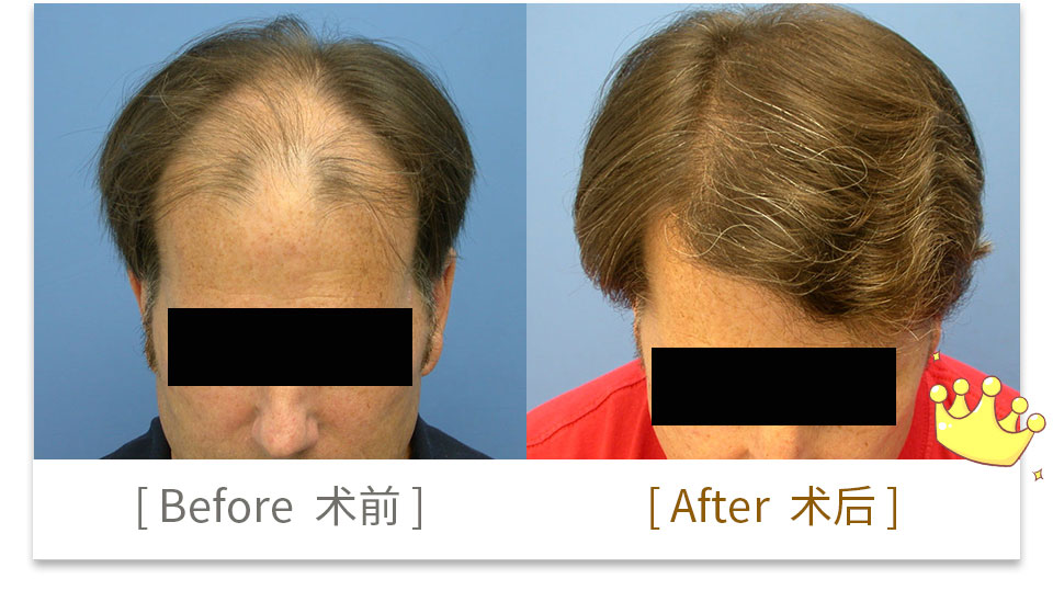 hair transplant china