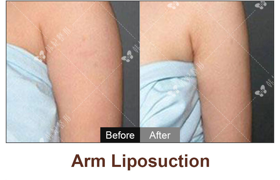 arms liposuction