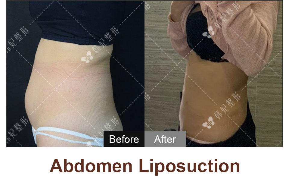 abdoman liposuction