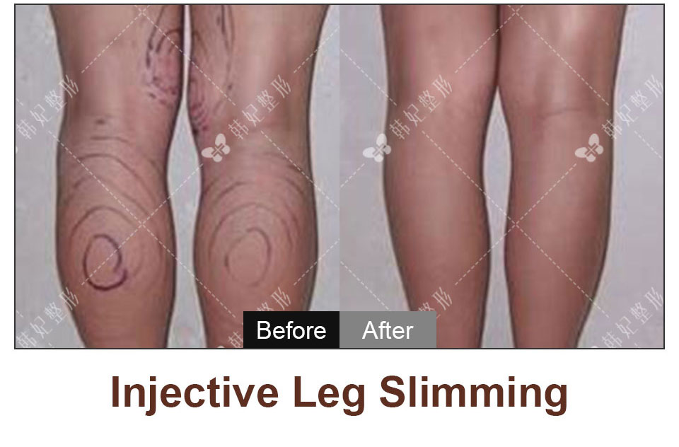 legs liposuction or injective leg slimming