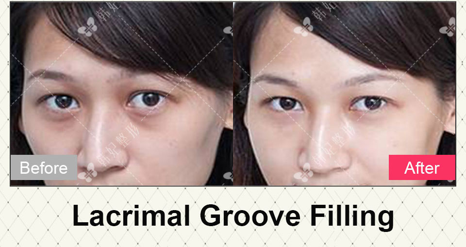 lacrimal groove filling